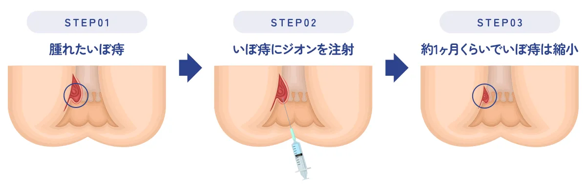 ジオン注射療法の概略